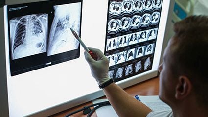 Experts Widen Criteria for Those Who Should Get Lung Cancer Screening